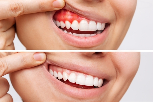 Bleeding Gums in Cleveland, TN | Gum Disease Signs | Treatment