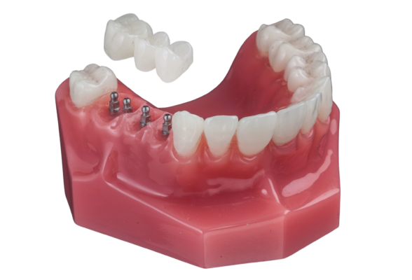 Partial Dentures in Cleveland, TN | Try a Dental Implant Alternative